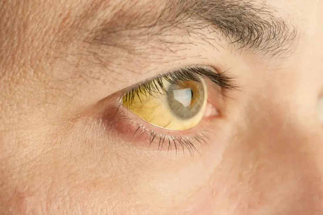 A sign that gave the disease its name - yellowing of the eyeball